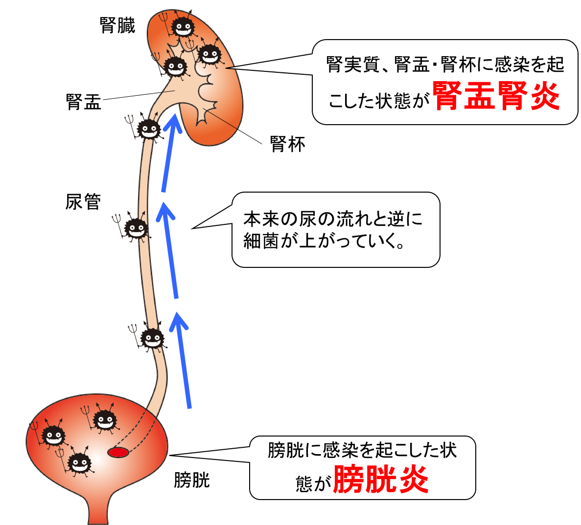 腎盂腎炎及び膀胱炎の図、イラスト