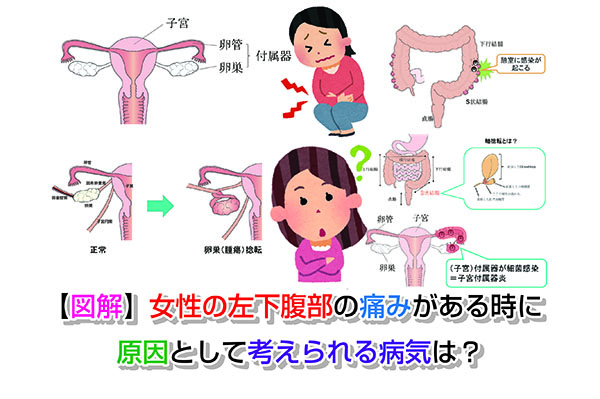 【図解】女性の左下腹部の痛みがある時に原因として考えられる病気は？ お腹の相談所