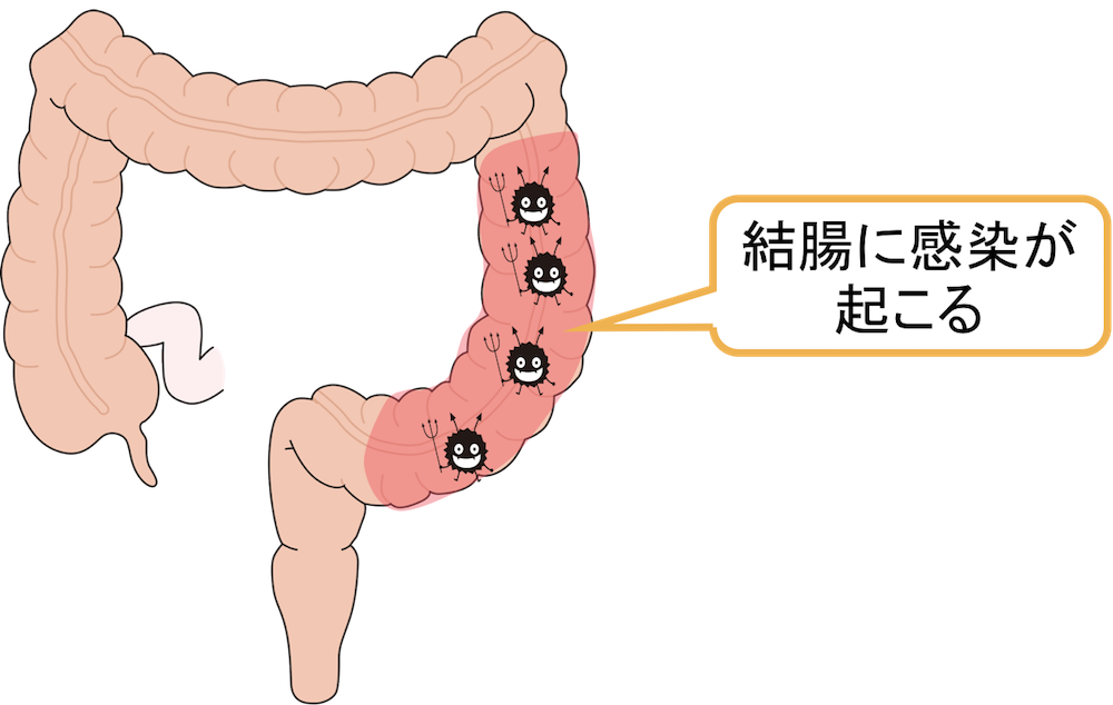 【図解】女性の左下腹部の痛みがある時に原因として考えられる病気は？ お腹の相談所