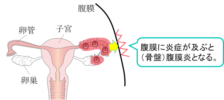 【図解】女性で下腹部が痛い＆腰痛がある時に考えられる病気とは？